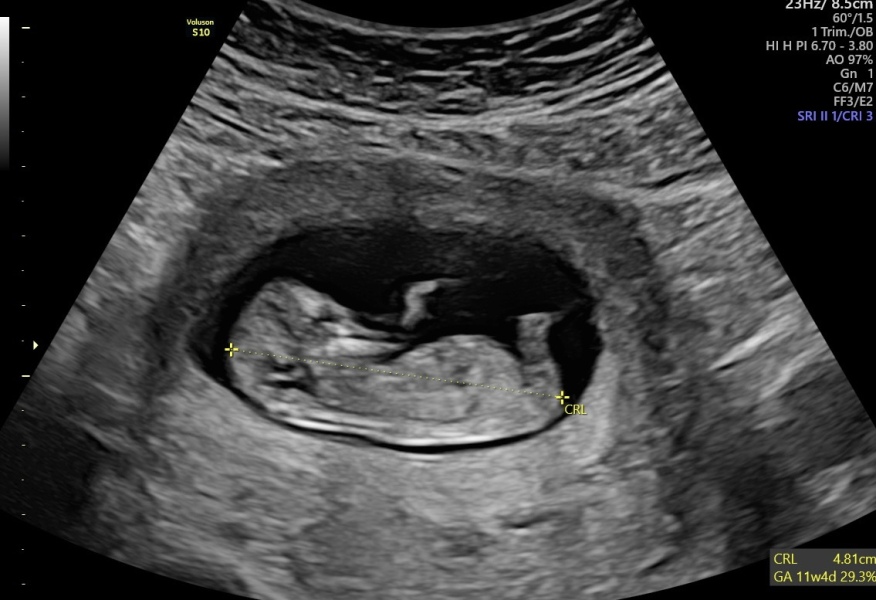 Nub theory guesses? 3rd baby!