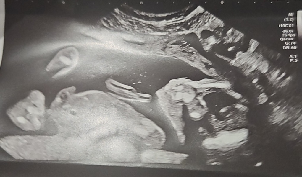 20 week scan pic. Girl or boy