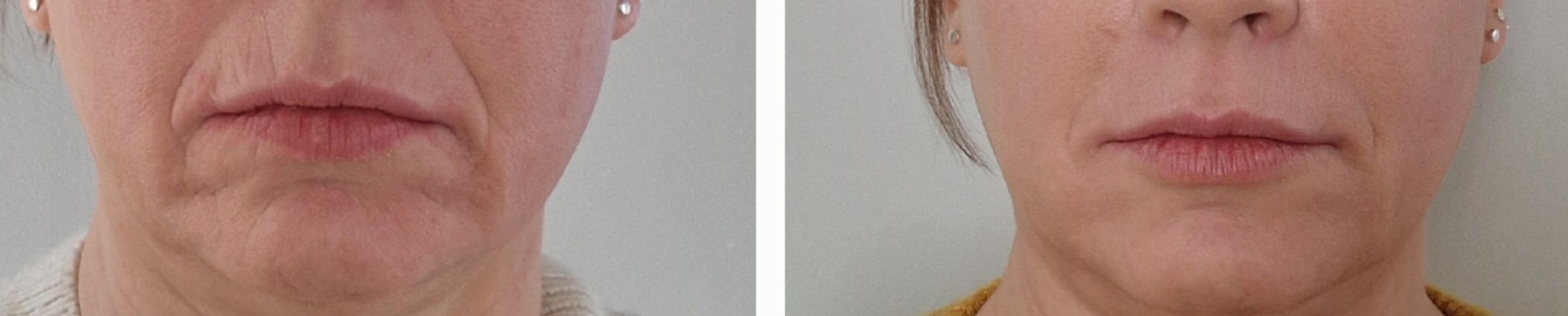 Botox or fillers? Help please
