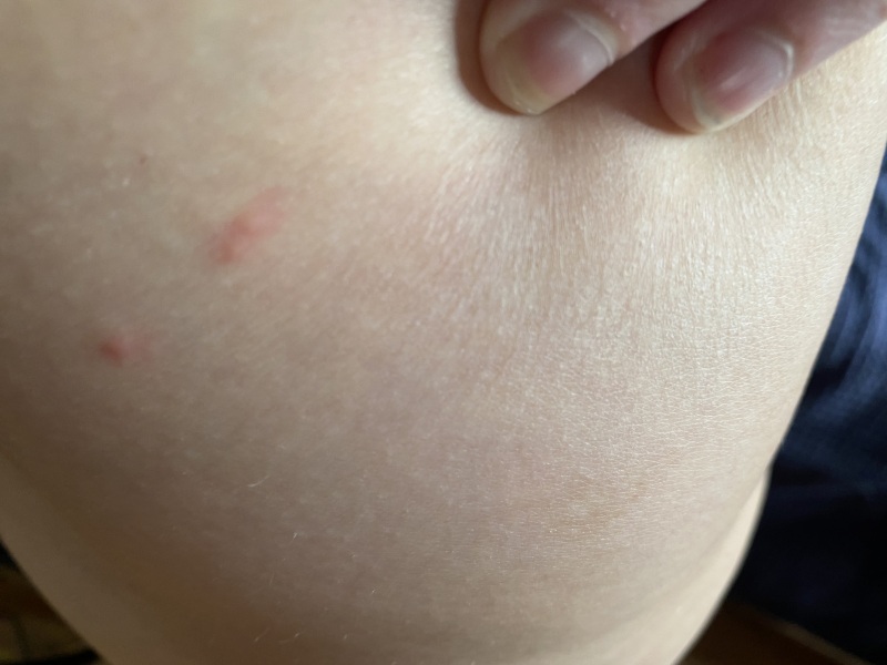 To think these are flea bites?
