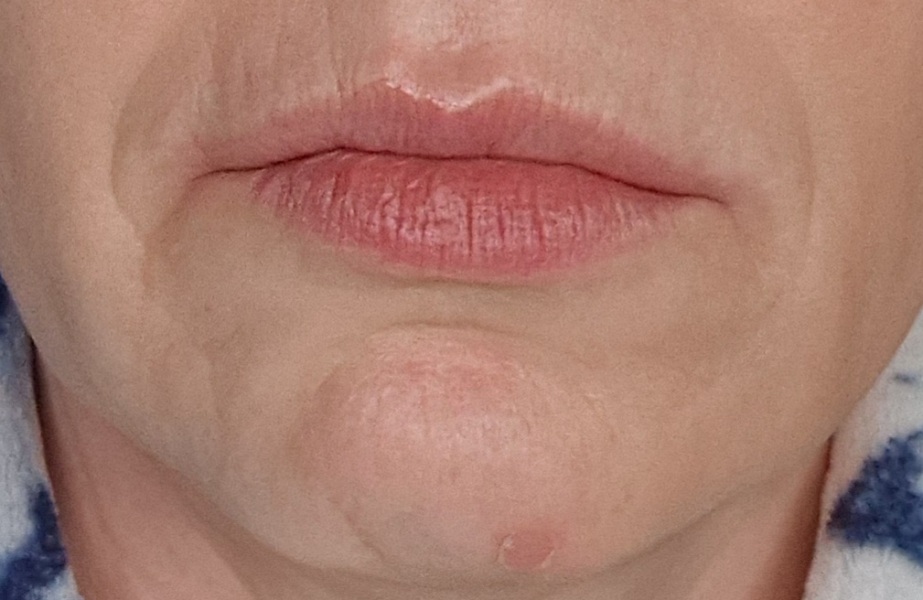 Botox or fillers? Help please