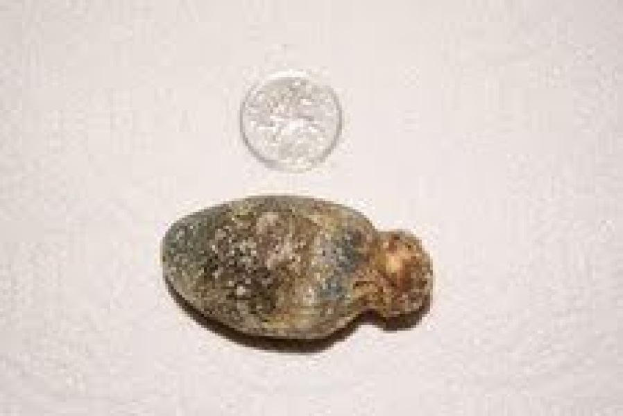 What do gallstones feel like