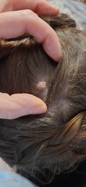 Weird looking mole on scalp