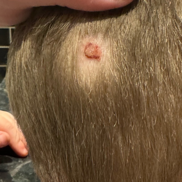 Suspicious nodule on 4y/o sons scalp