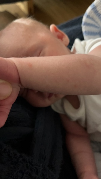 Newborn spots? Internet unable to help!