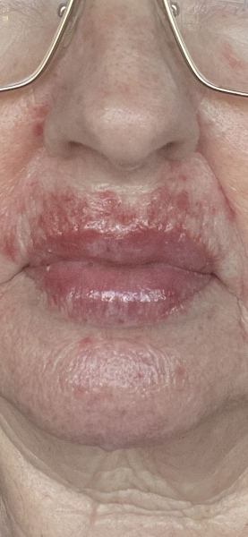 Cream/serum for upper lip wrinkles