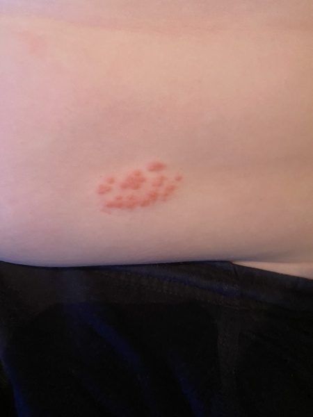 Son has rash on stomach but no other symptoms