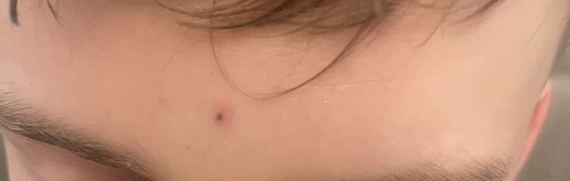 Deep blackhead on DS's forehead. Ideas for removal