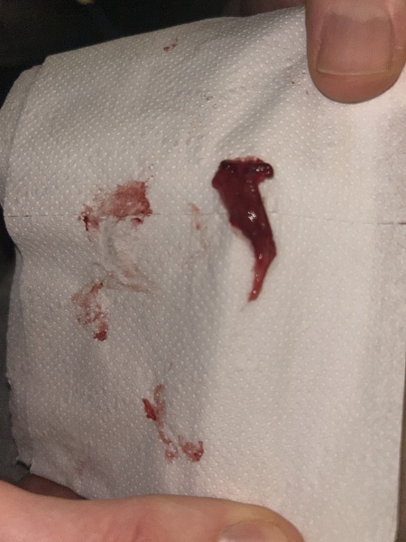 Heavy bleeding 6 weeks - pic attached