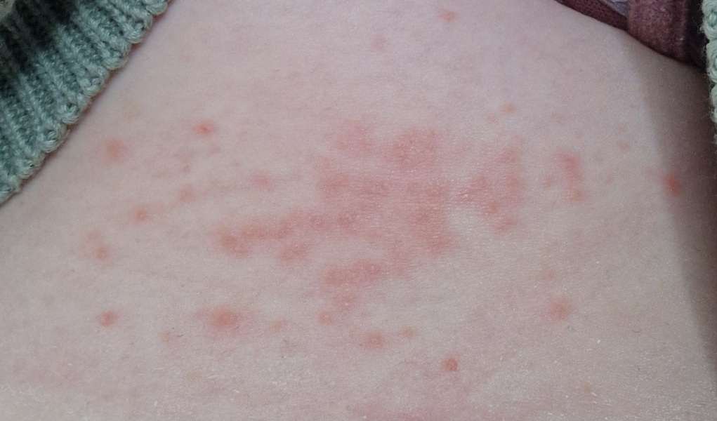 Is this shingles?!