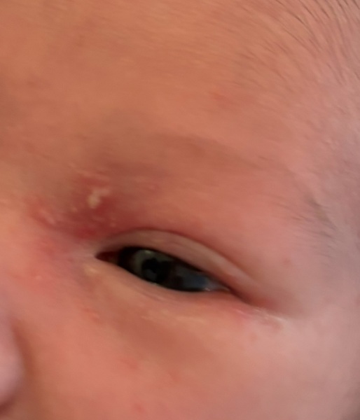Neonatal herpes or baby acne