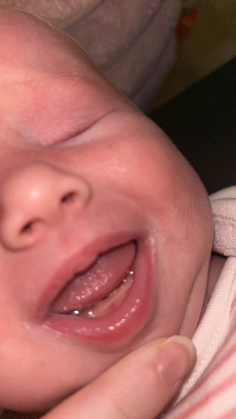 Tongue tie?