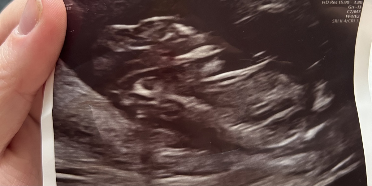 Referred to fetal medicine