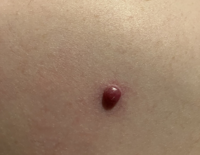 pregnancy panic - red skin lump appearance
