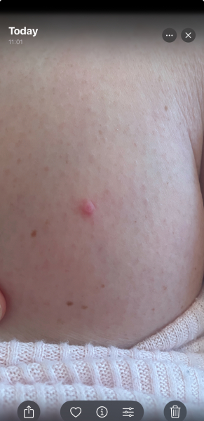Skin spot - Has anyone had anything that looks like this?