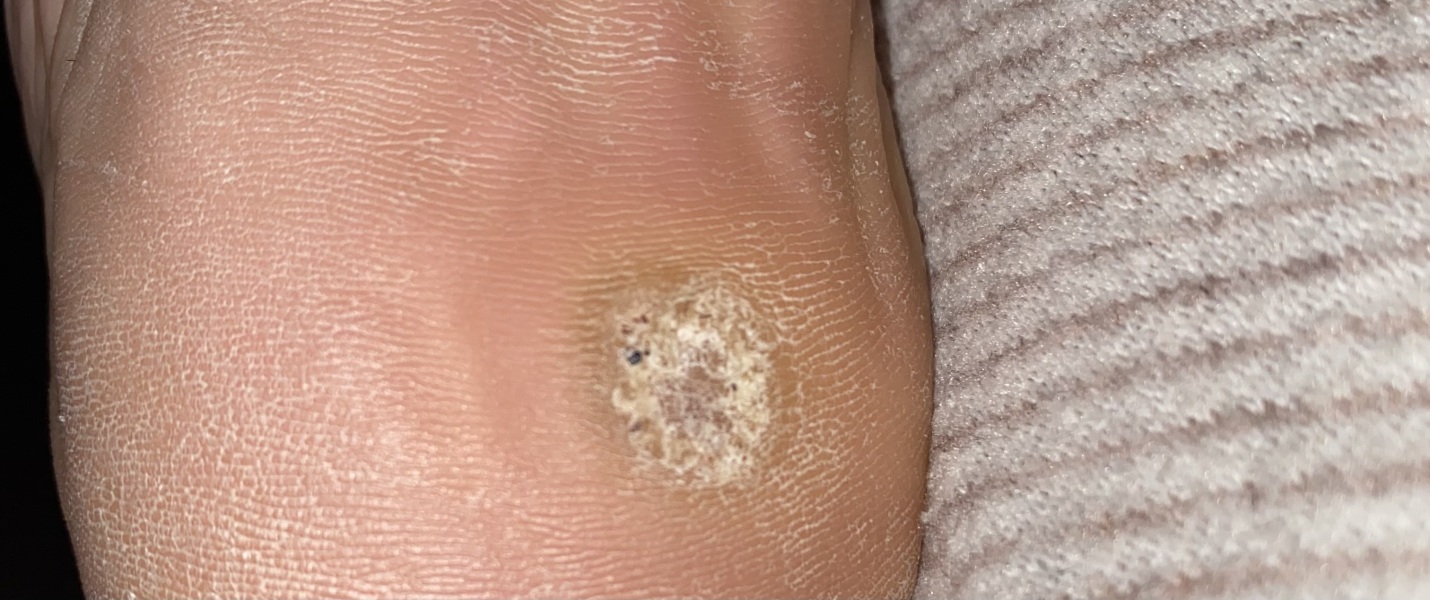 *Verruca picture* To think I can get rid of this verruca with over the counter treatment?