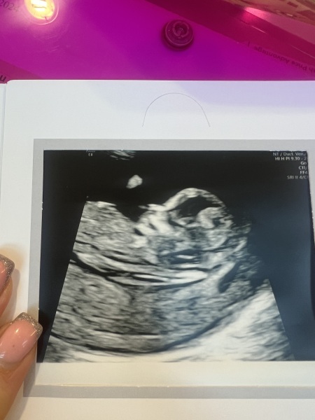 11DPO positive - but concerned