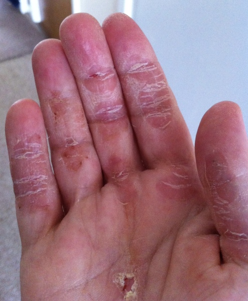 Had a nasty reaction to deep heat, not sure if I need to go to a&e or GP’s
