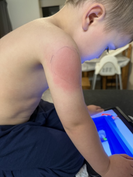 Post Vaccination redness?