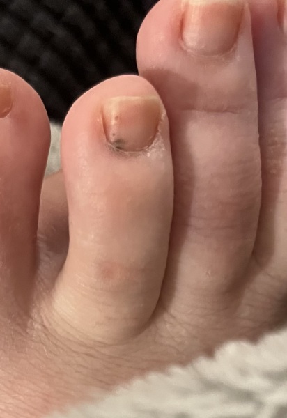 Black mark on toenail