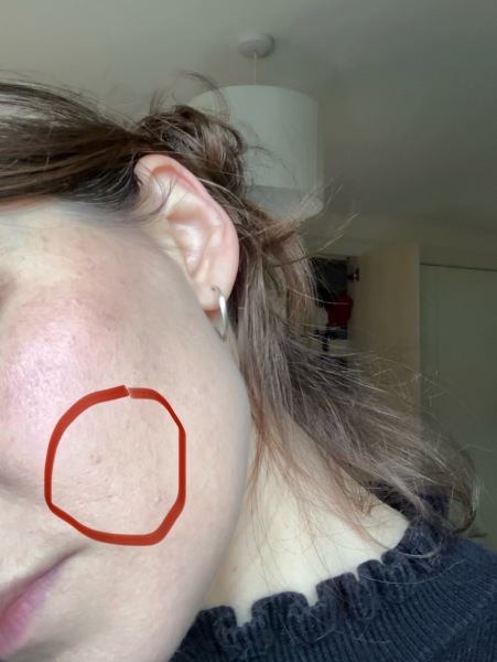 What to do to improve skin/light acne scarring/hyoerpigmentation?