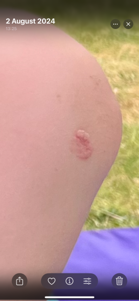 Could this be skin cancer?
