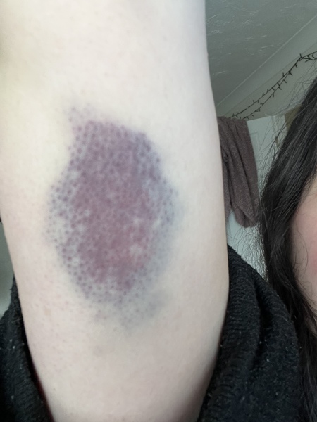 Random bruise? Third trimester