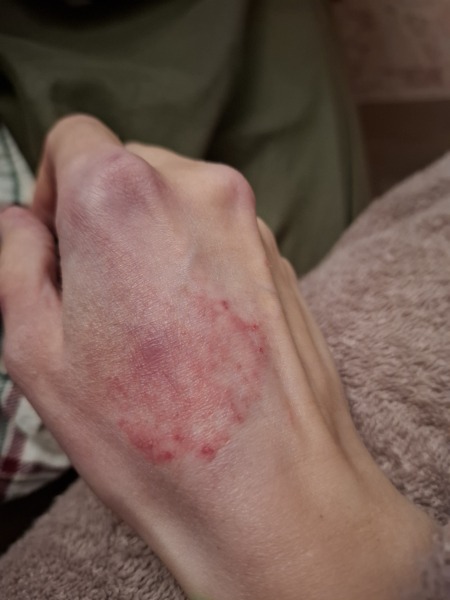 Hand infected (Warning, gross photos)