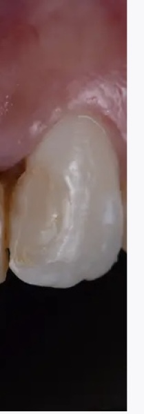Teeth whitening - home kit for around 50 quid or go to the dentist for about 300?