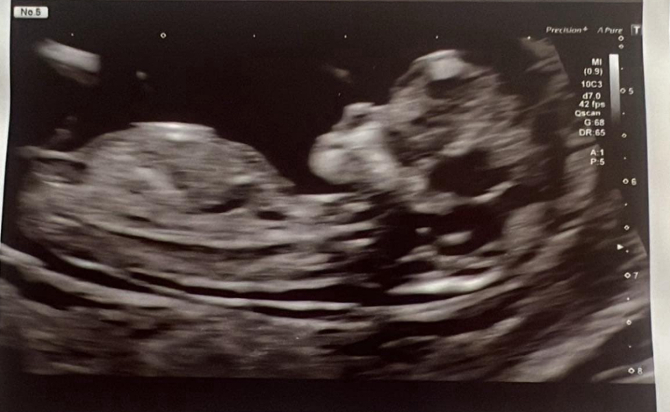 Can anyone guess the gender of my baby with the nub theory please? :)