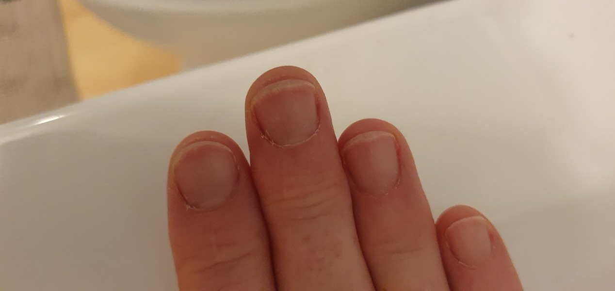 I need a miracle cure for my poor nails
