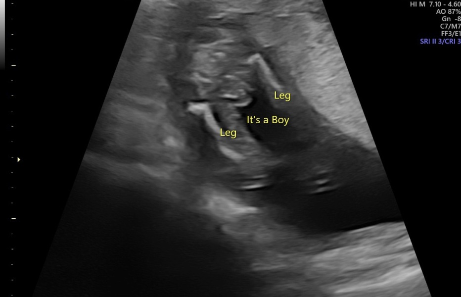 Gender scan