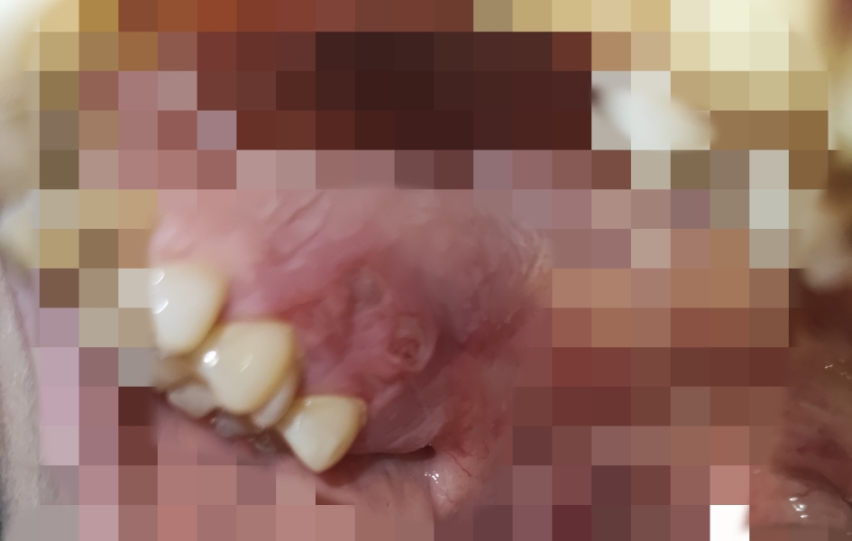 Super painful mouth burn