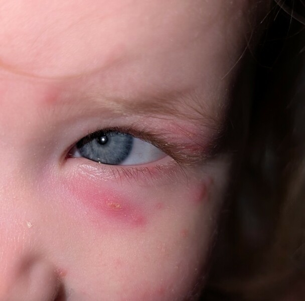 Chicken pox - is this ok?