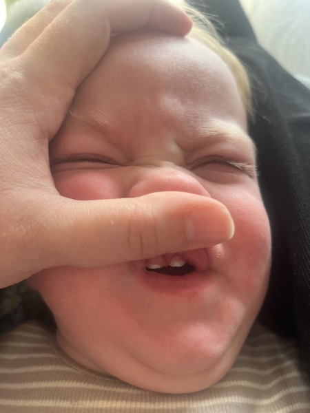 Spots on baby teeth