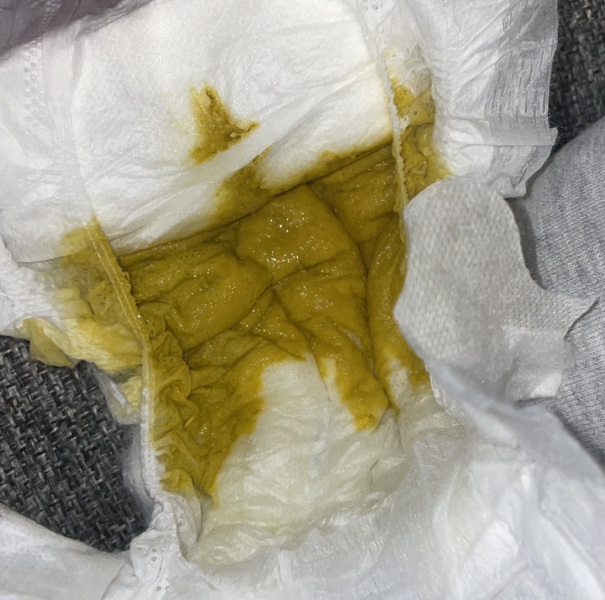 Baby poo PHOTO TRIGGER WARNING