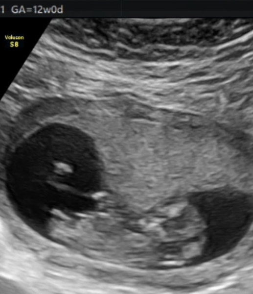 12 week scan, any gender guesses?