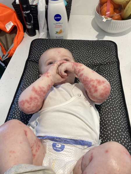 Chicken pox