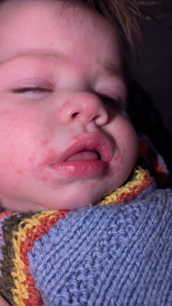 Can you help me identify this rash/spots?