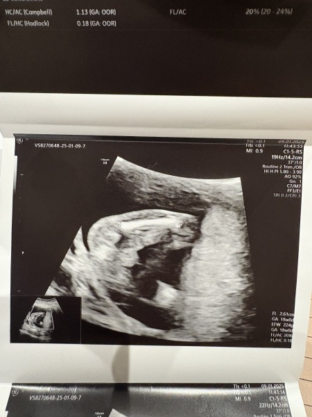 Gender guess from femur scan measurement