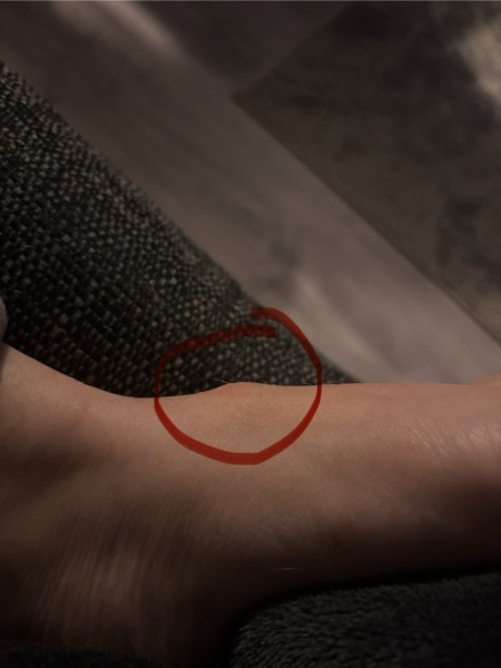 Likelihood of it being a broken bone?
