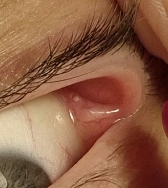 Stye? Pic of my eye socket
