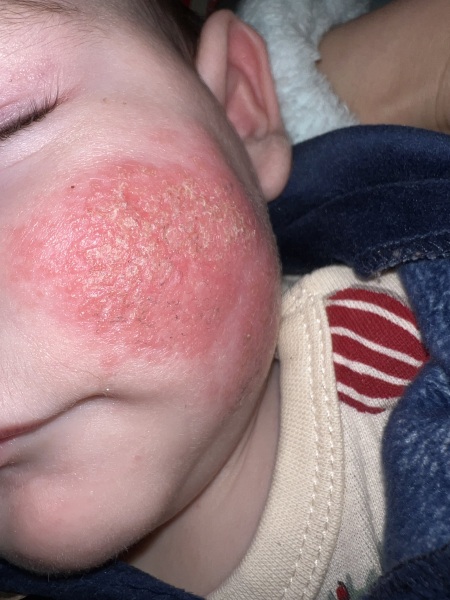 Eczema or something else?