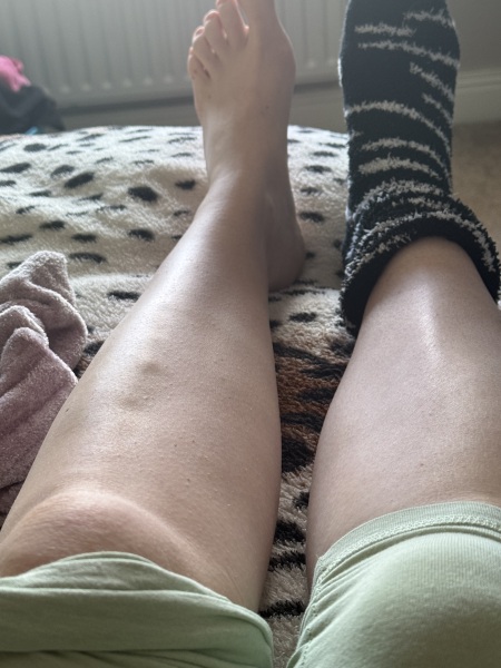 Lump on shin bone