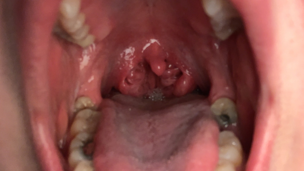 Do these tonsils need to come out? TW!