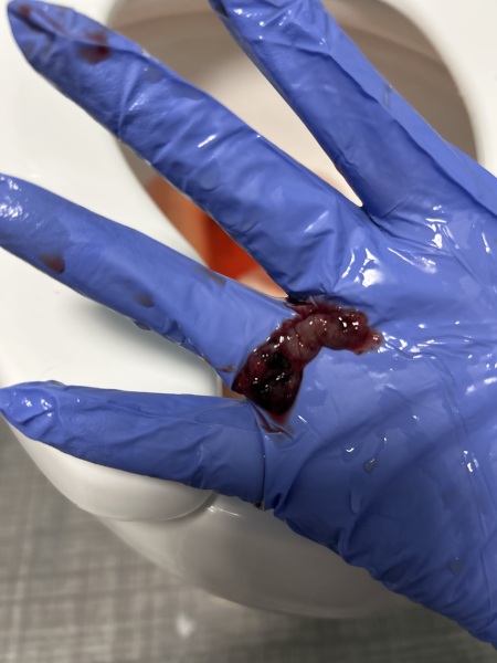 Did I just Miscarry ?**CONTAINS SENSITIVE IMAGES**