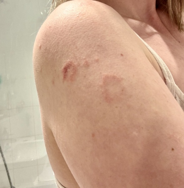 Is this definitely ringworm?