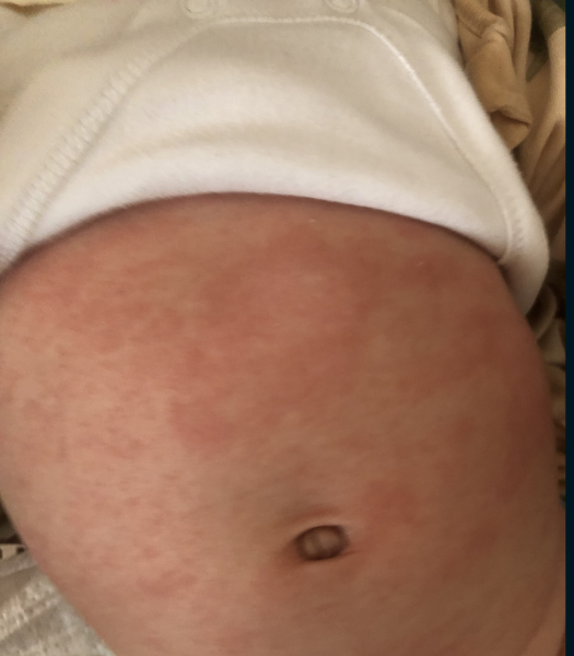 Eczema or something else?