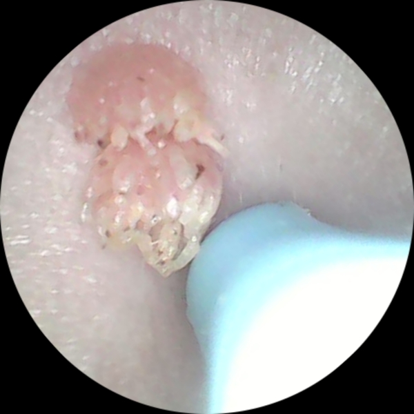 Suggestions on how to remove a wart (picture included)