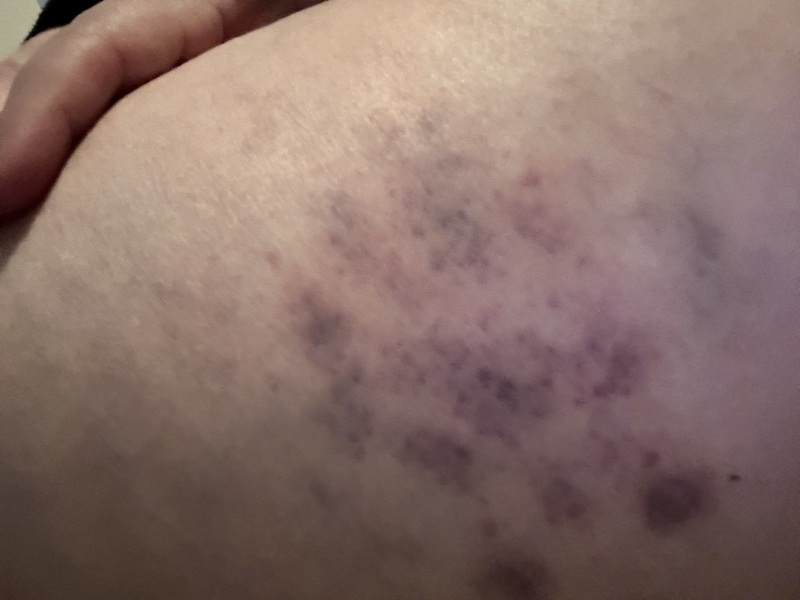 Unexplained Bruising?